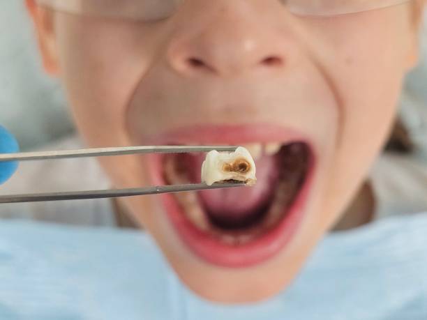 Best Emergency Treatment for Dental Infections or Abscesses in Tamiami, FL